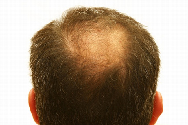 regrow dead hair follicles